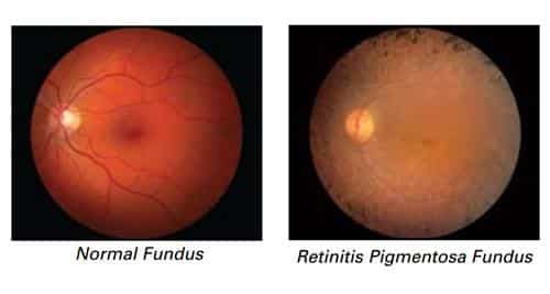La retinitis pigmentosa es una enfermedad hereditaria y sería el problema para quienes consumen Viagra.